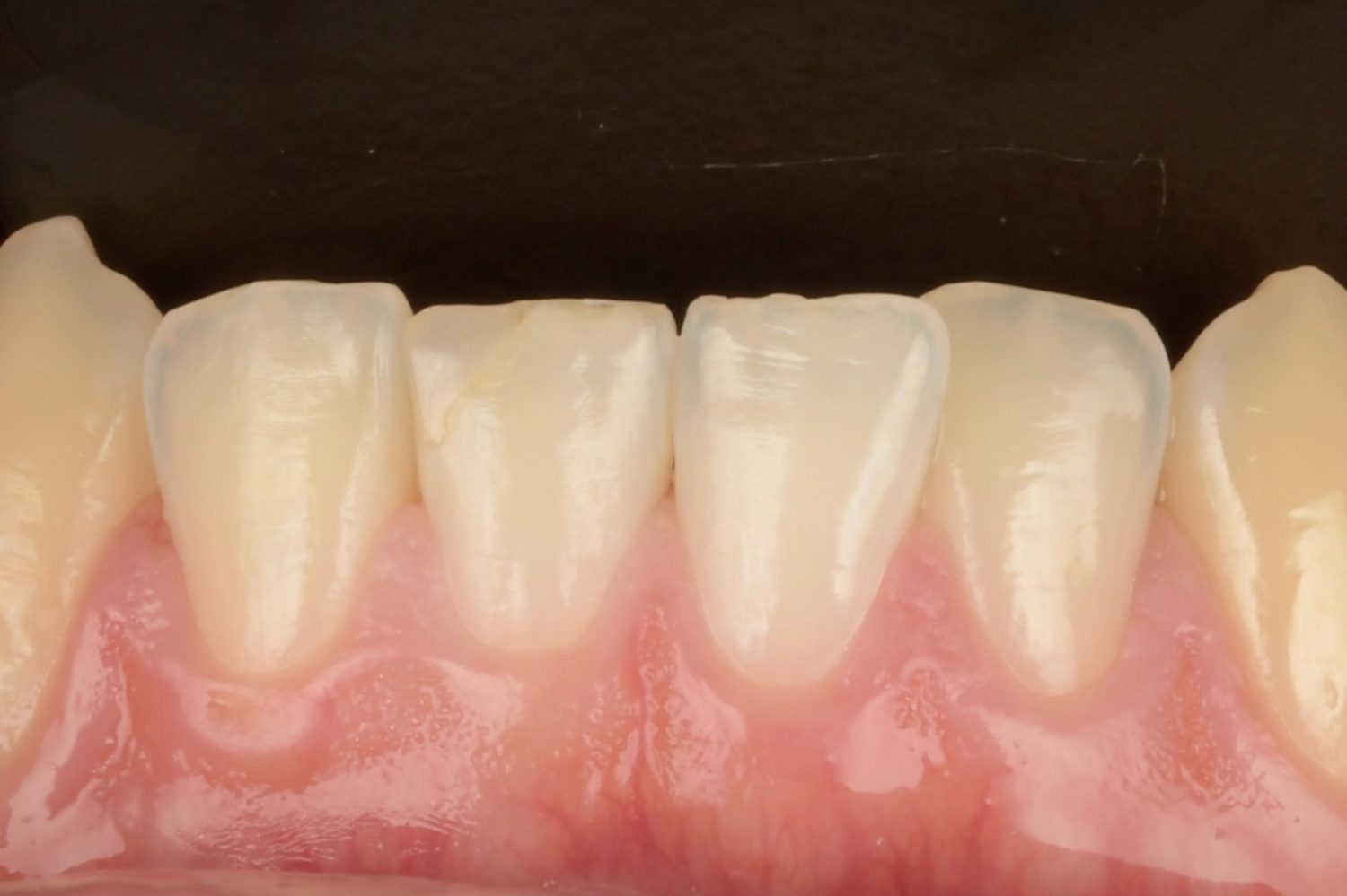 3D Printed Fractional Veneer detail 2