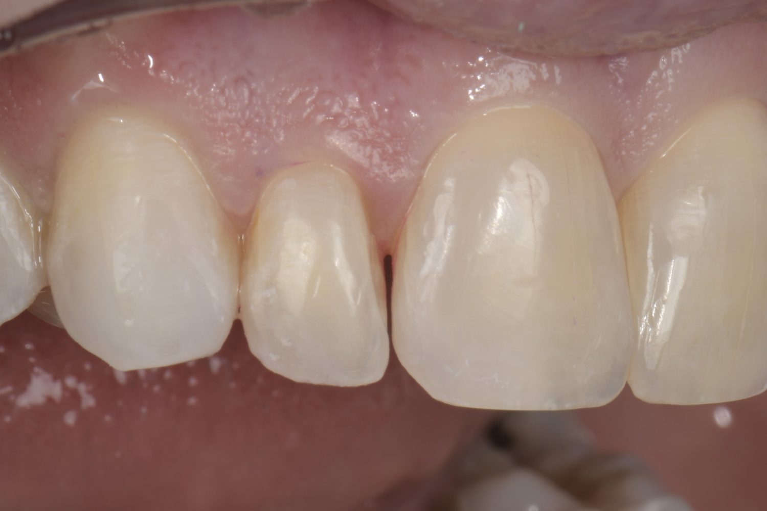 Bioclear before treatment