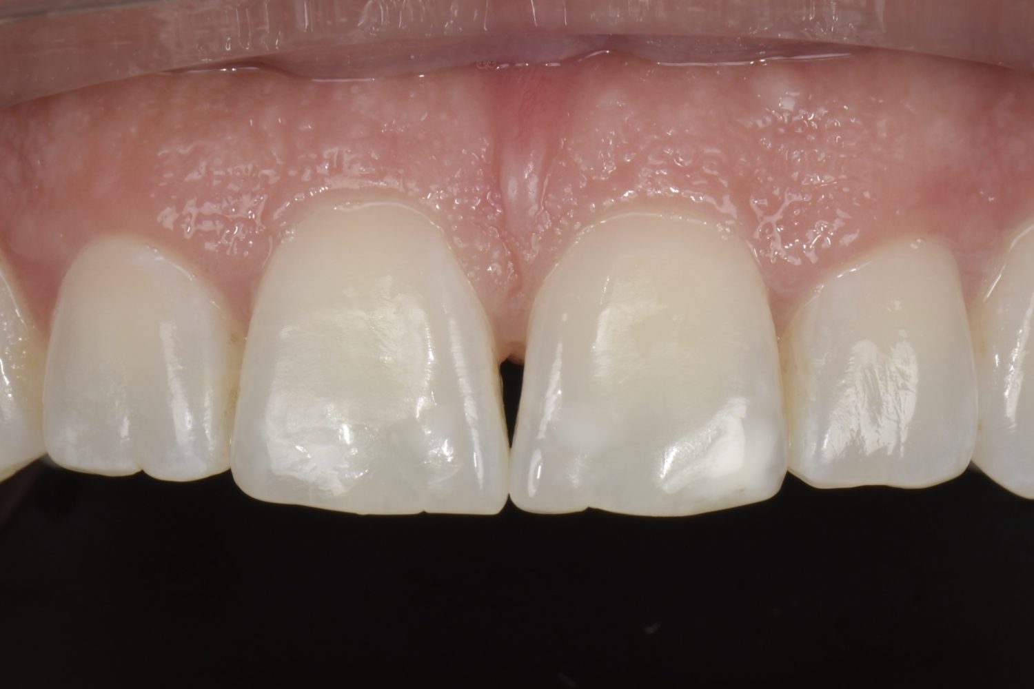Bioclear detail 2