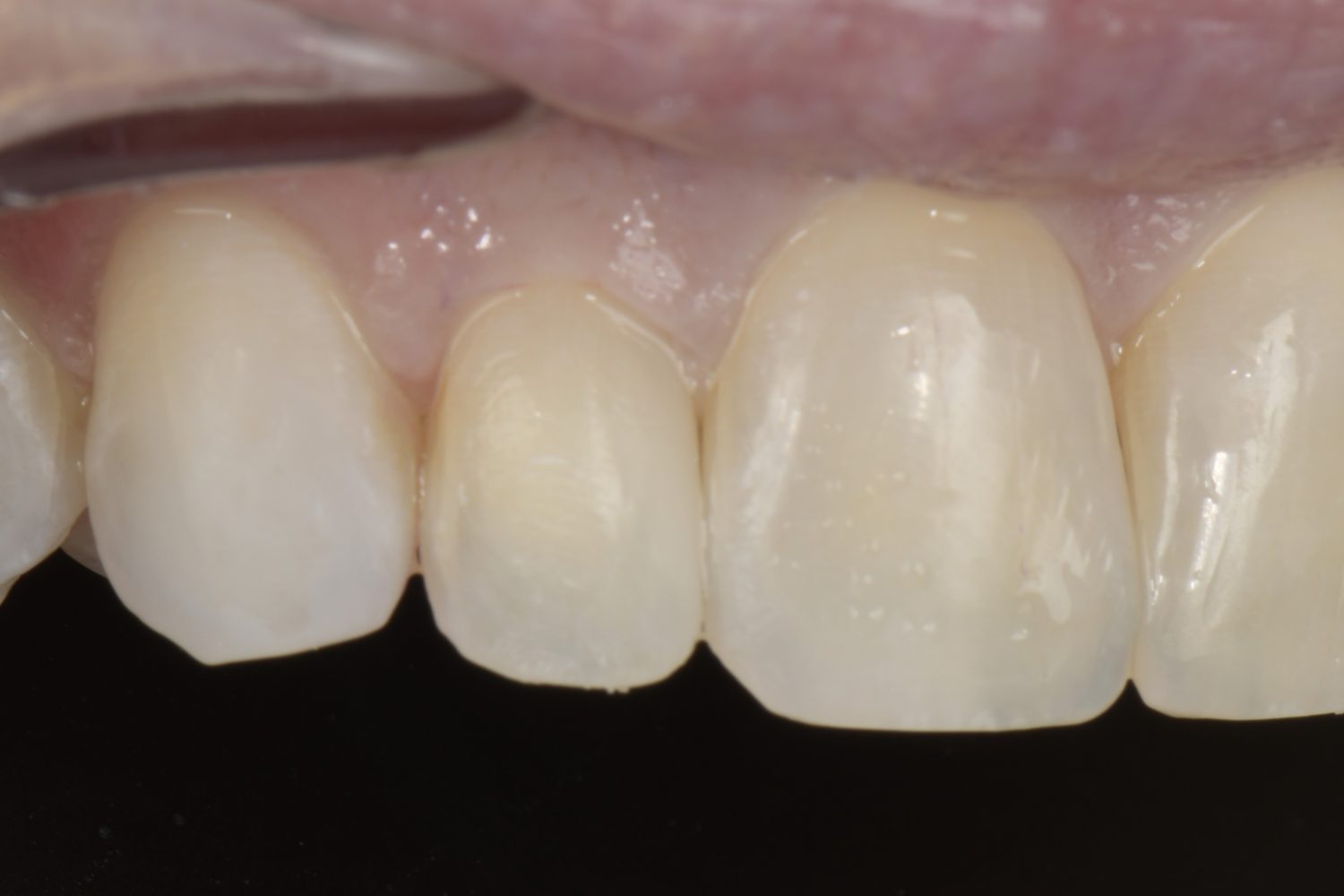 Bioclear detail 1