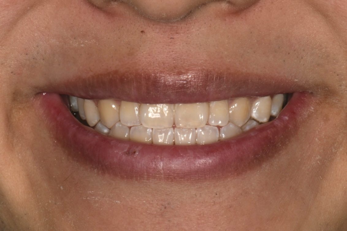 Icon white spot removal after