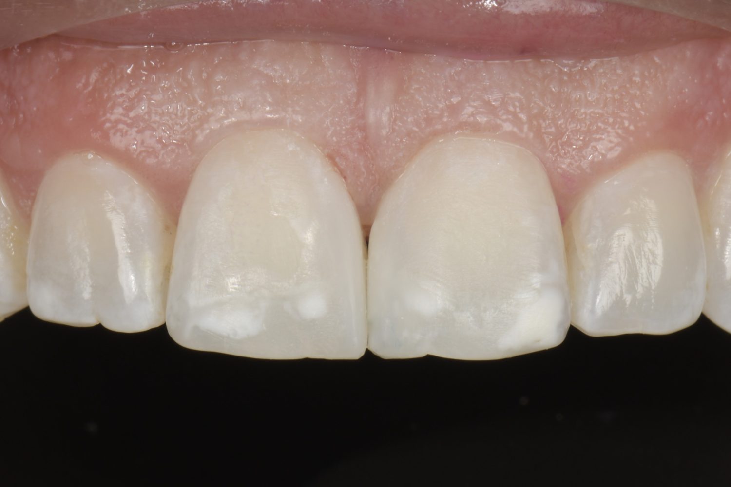 Bioclear detail 3