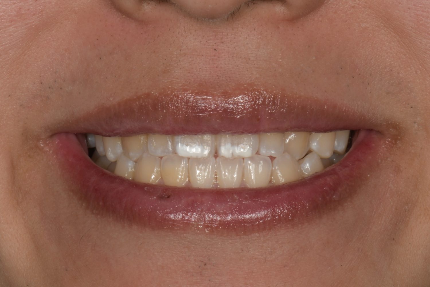 Icon white spot removal before