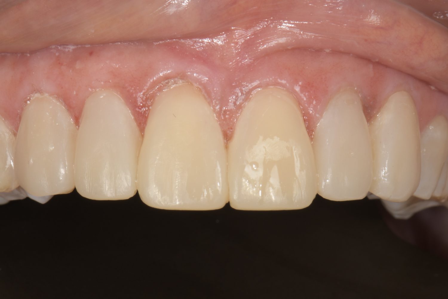 Injected resin veneers view 2