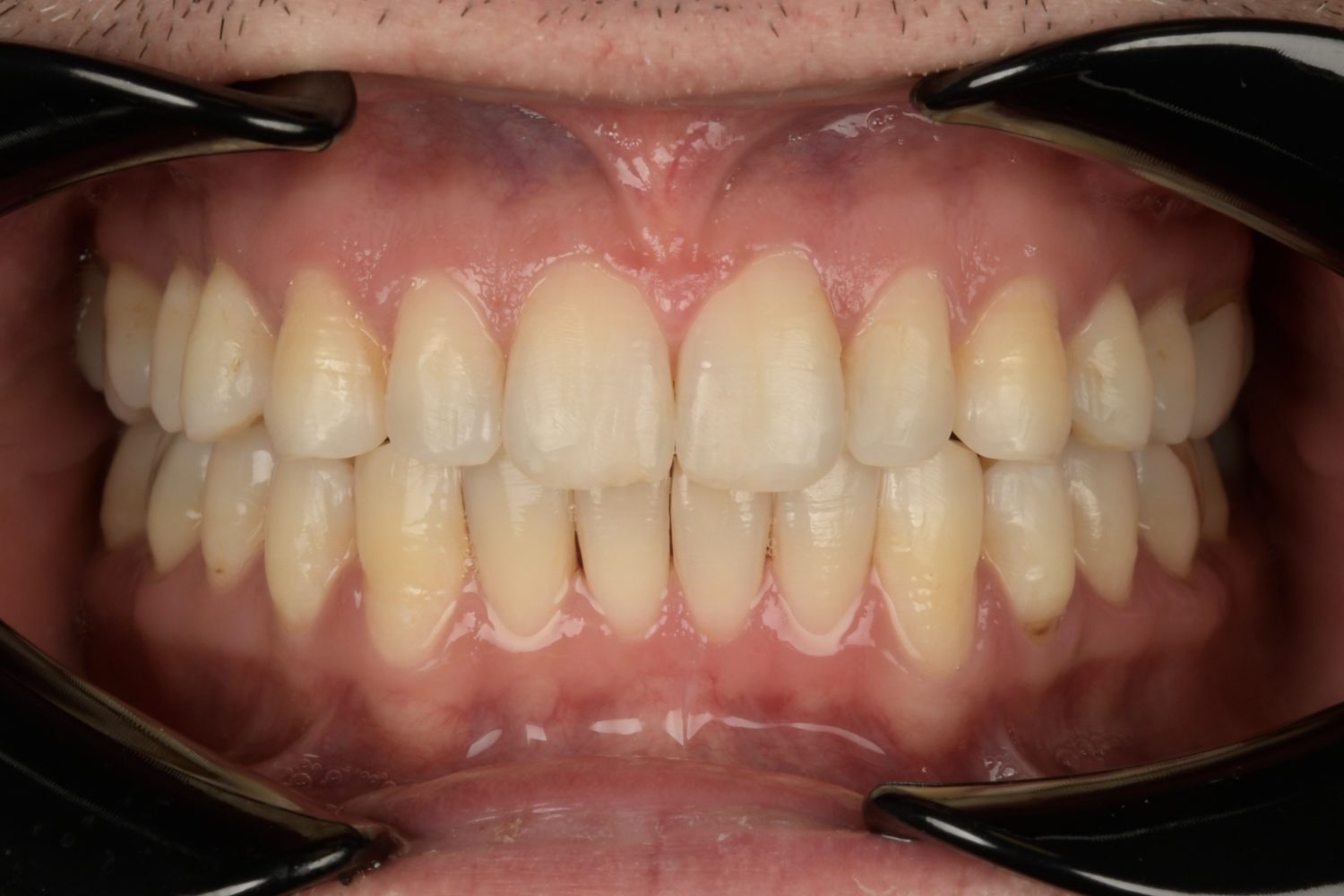 Invisalign detail 1