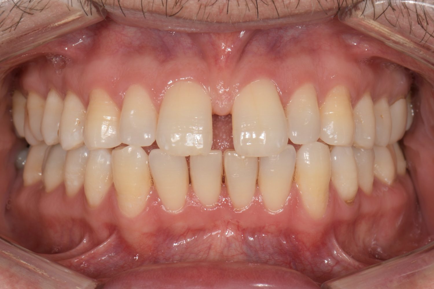 Invisalign detail 2