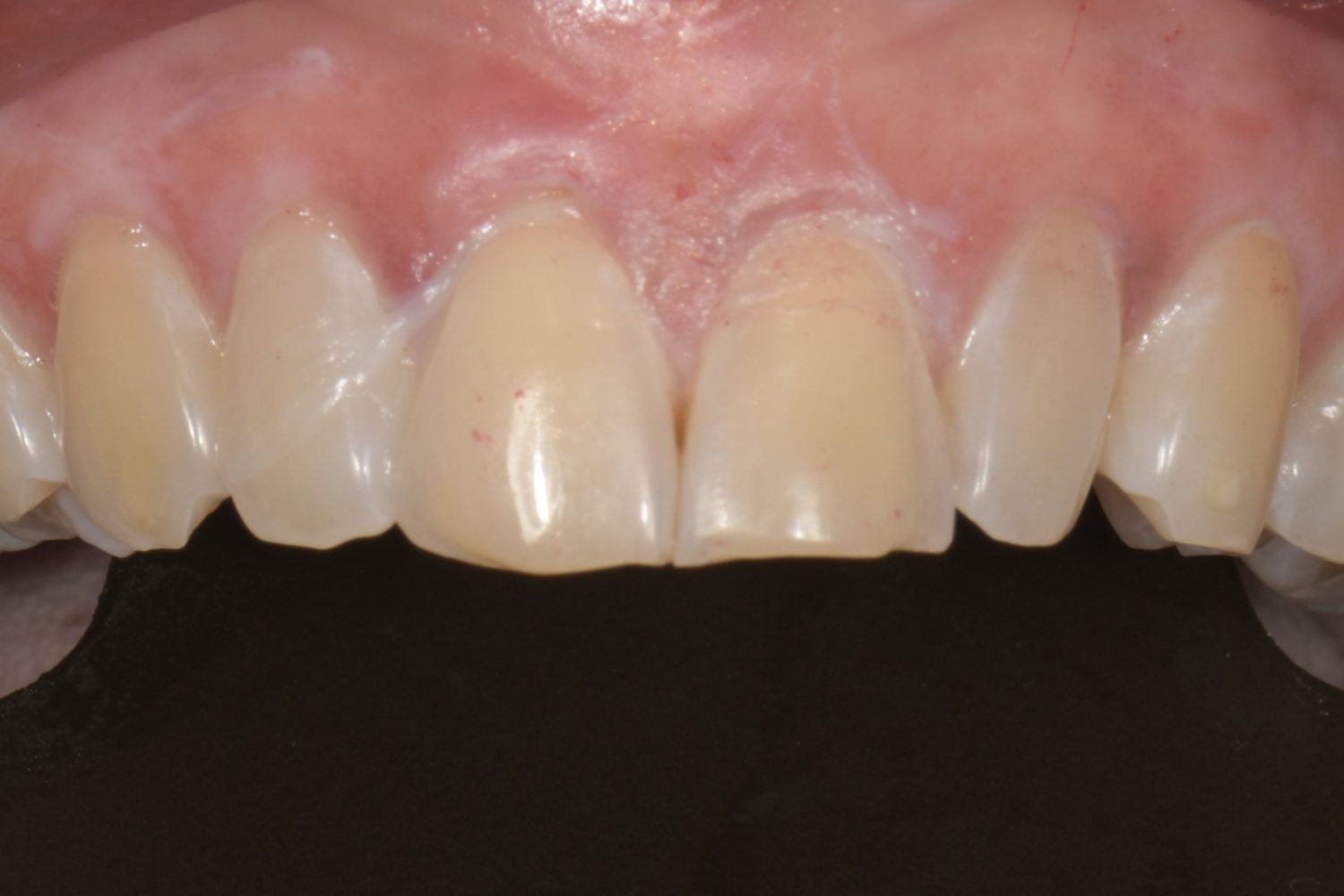 Injected resin veneers view 1