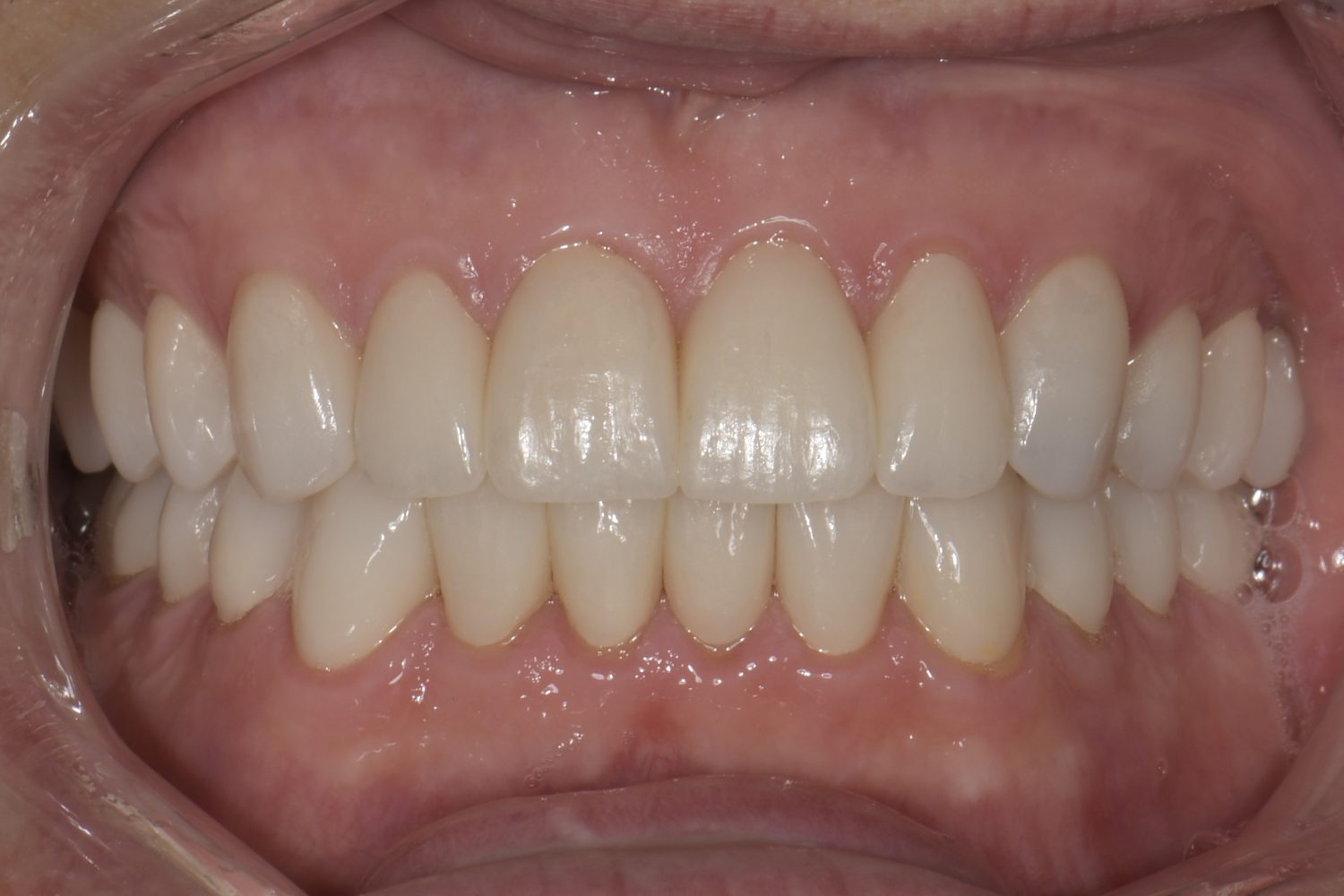 Porcelain Full Mouth detail 4