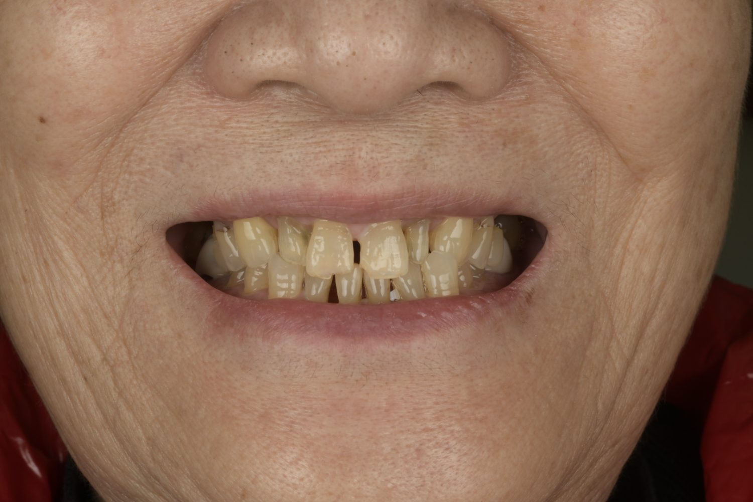 Printed full mouth before smile
