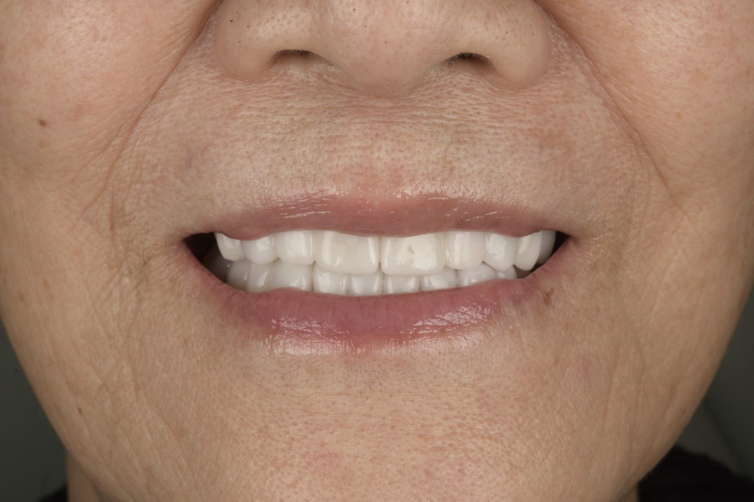 Printed full mouth after smile