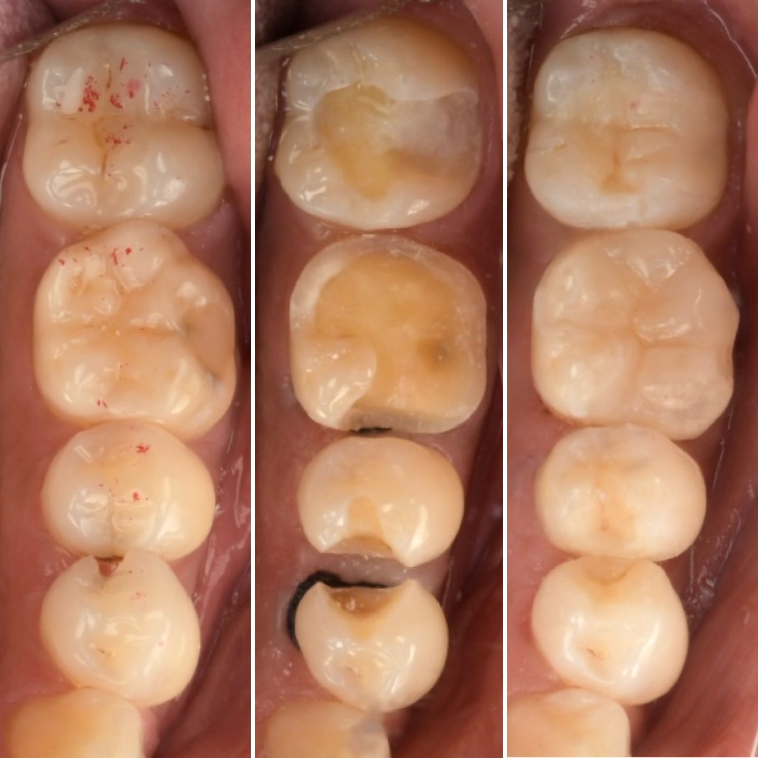 Same day 3D printed restoration comparison