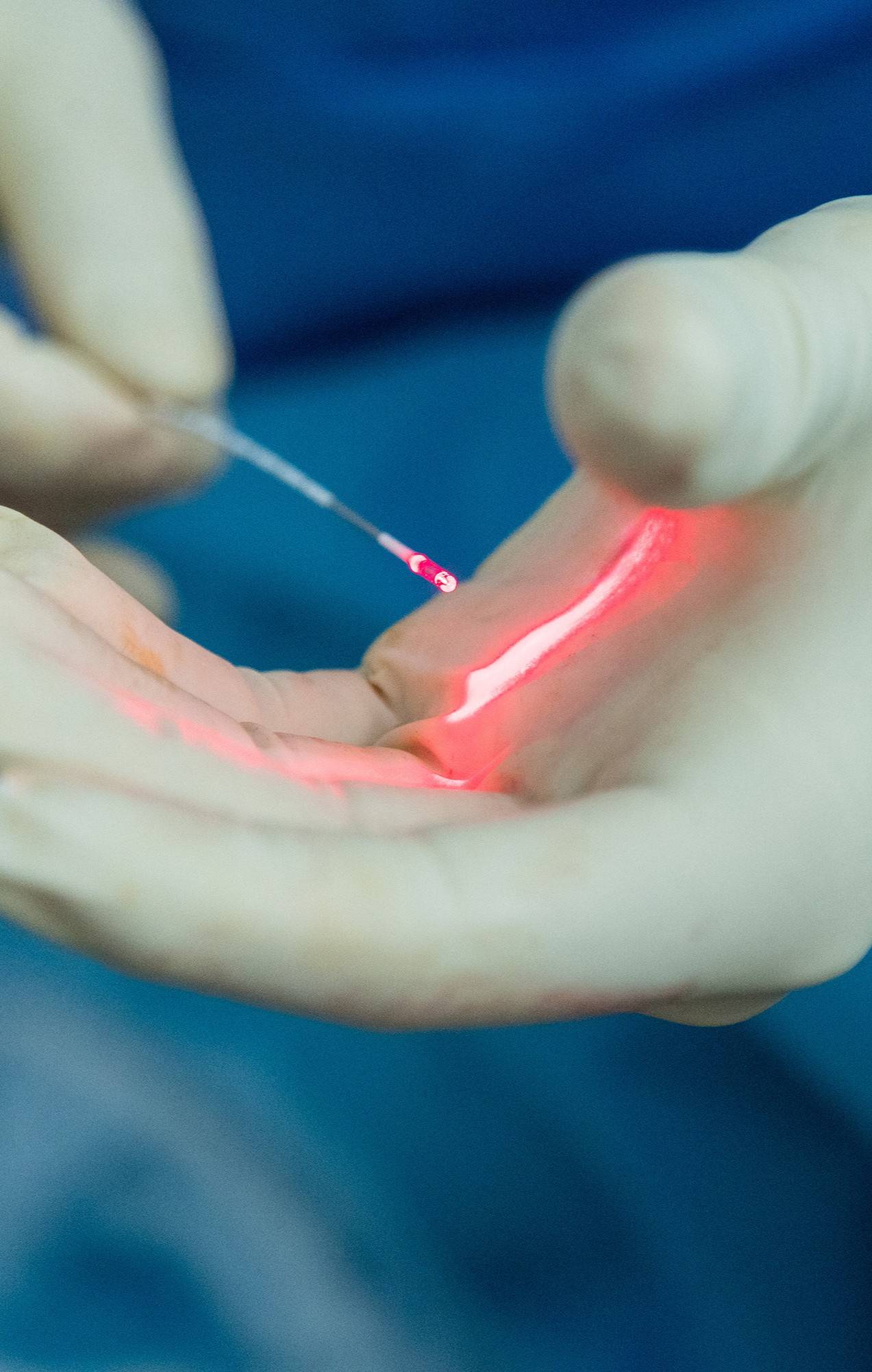 Włókno światłowodowe do laserowego usuwania żylaków (EVLT) w gabinecie w Smart Medica w Łazach pod Warszawą