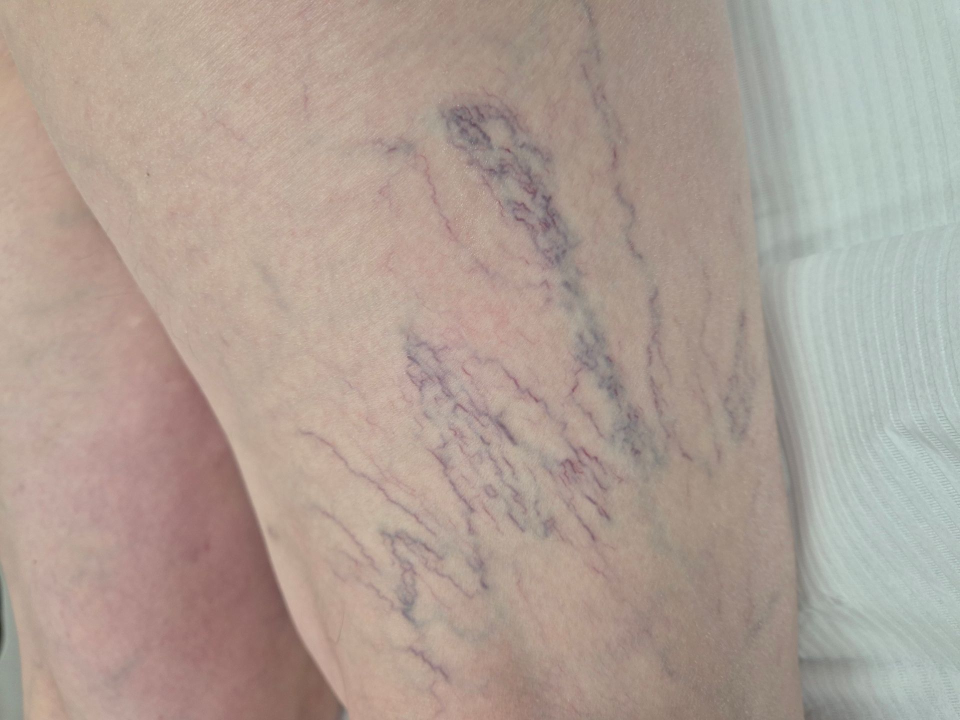 Pajączki na nogach usuwane w gabinecie zabiegowym Smart Medica