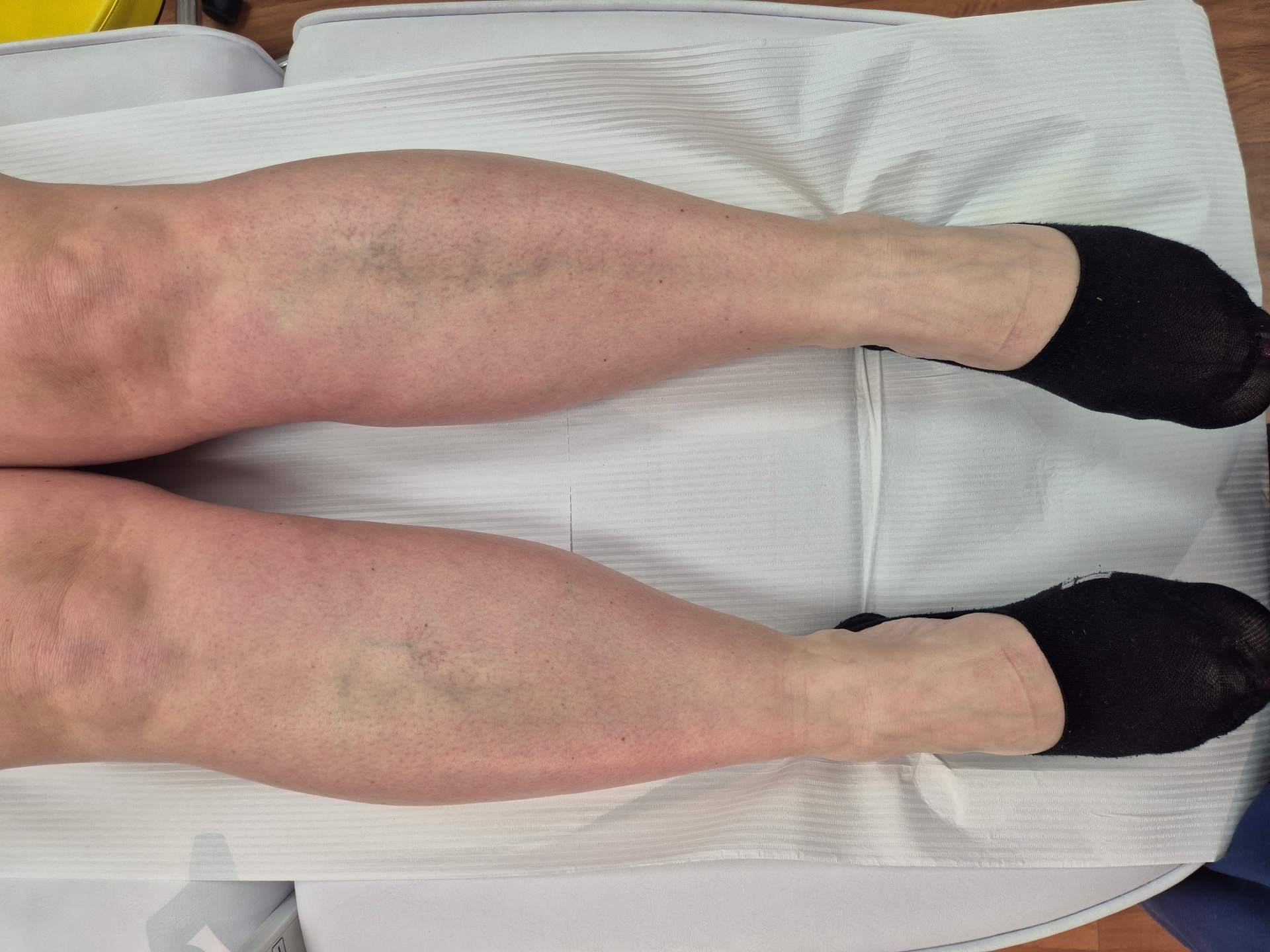 Objawy pajączków na nogach u pacjentki w przychodni specjalistycznej Smart Medica w Łazach pod Warszawą