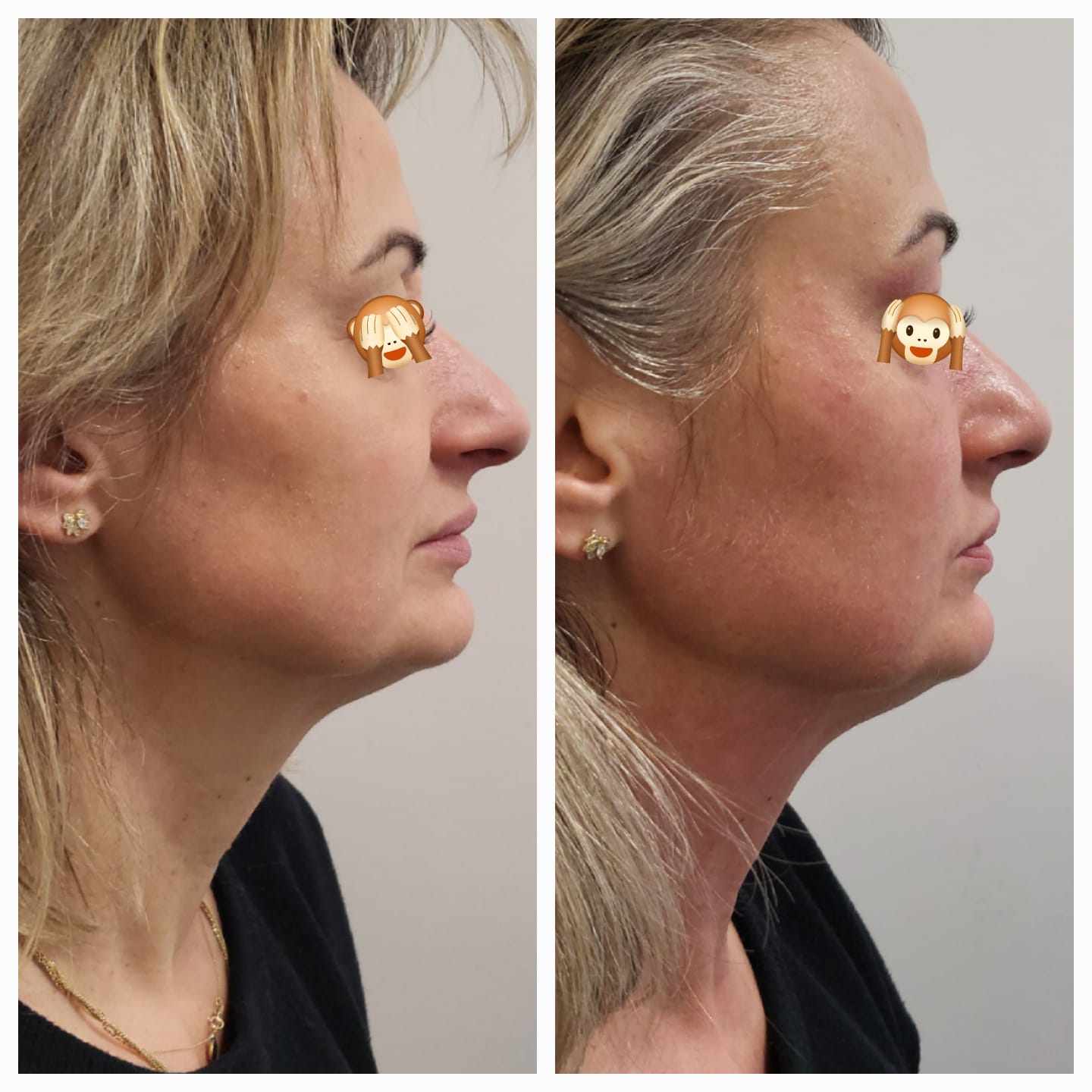 Efektu przed i po zabiegu laserowego liftingu twarzy FOTONA