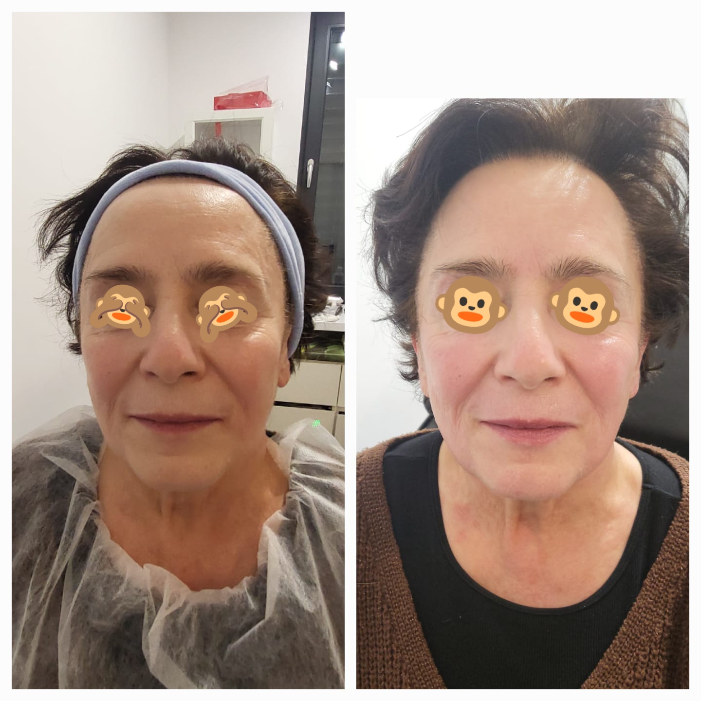 Efektu przed i po zabiegu laserowego liftingu twarzy FOTONA