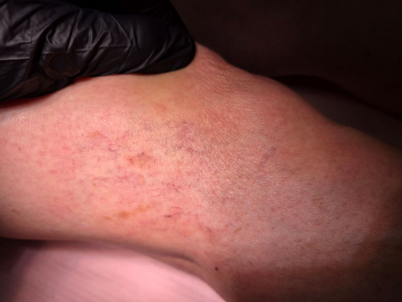 matting na nodze przed leczeniem laserowym