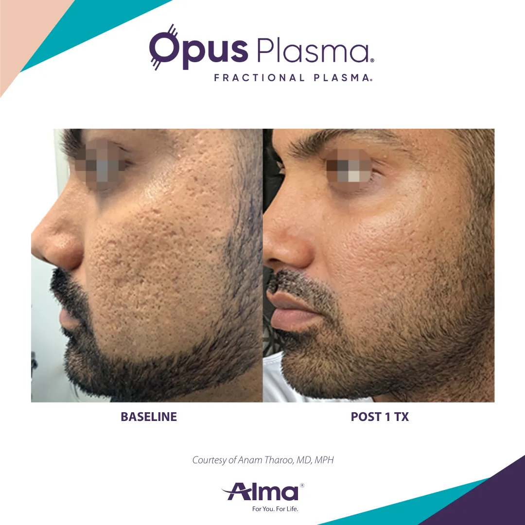 Side-by-side images of a man's cheek showing skin texture improvement after one Opus Plasma treatment.