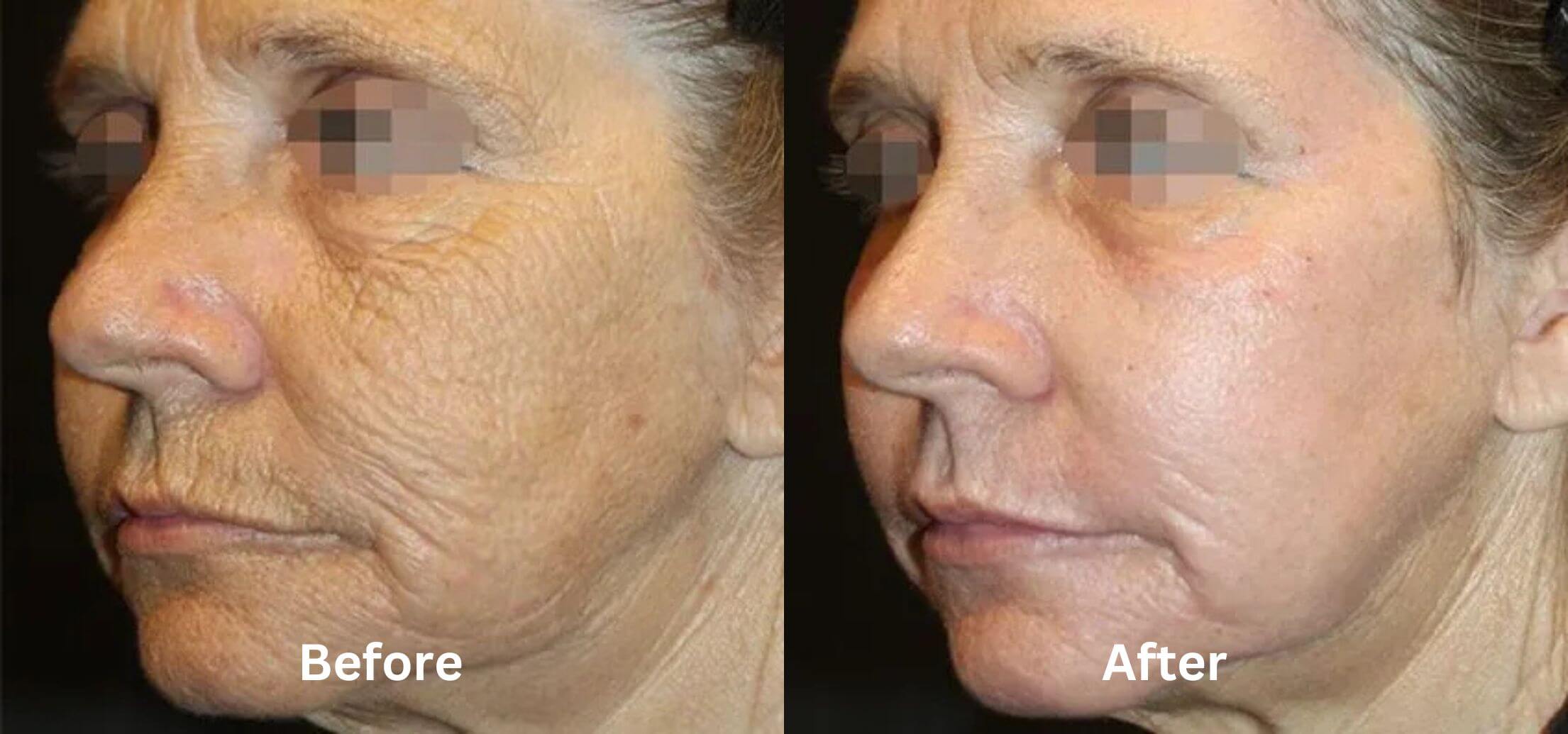 Alma Hybrid skin rejuvenation before and after at Sanctuary Laser Pennington — patient two
