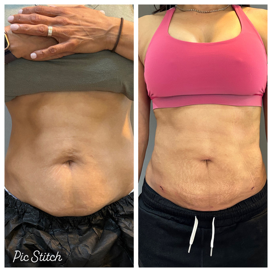 BeautiFill laser lipo plus fat transfer before and after at Sanctuary Laser Pennington, patient three.