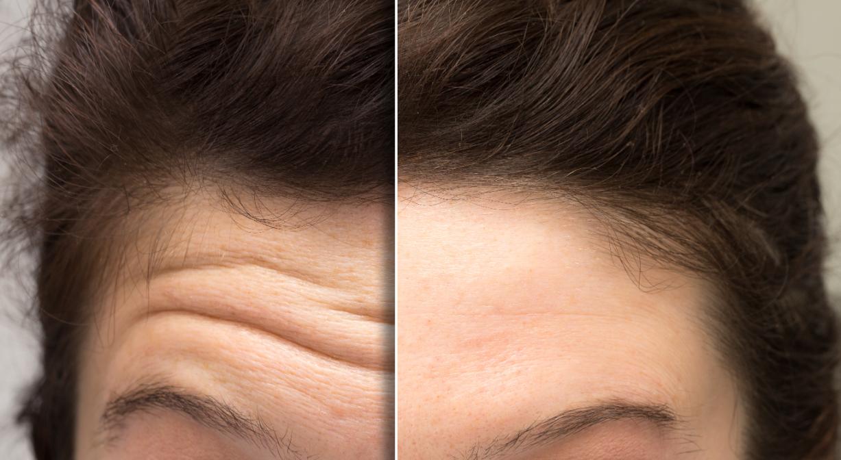 Juvederm filler products at Sanctuary Laser in Pennington, NJ.