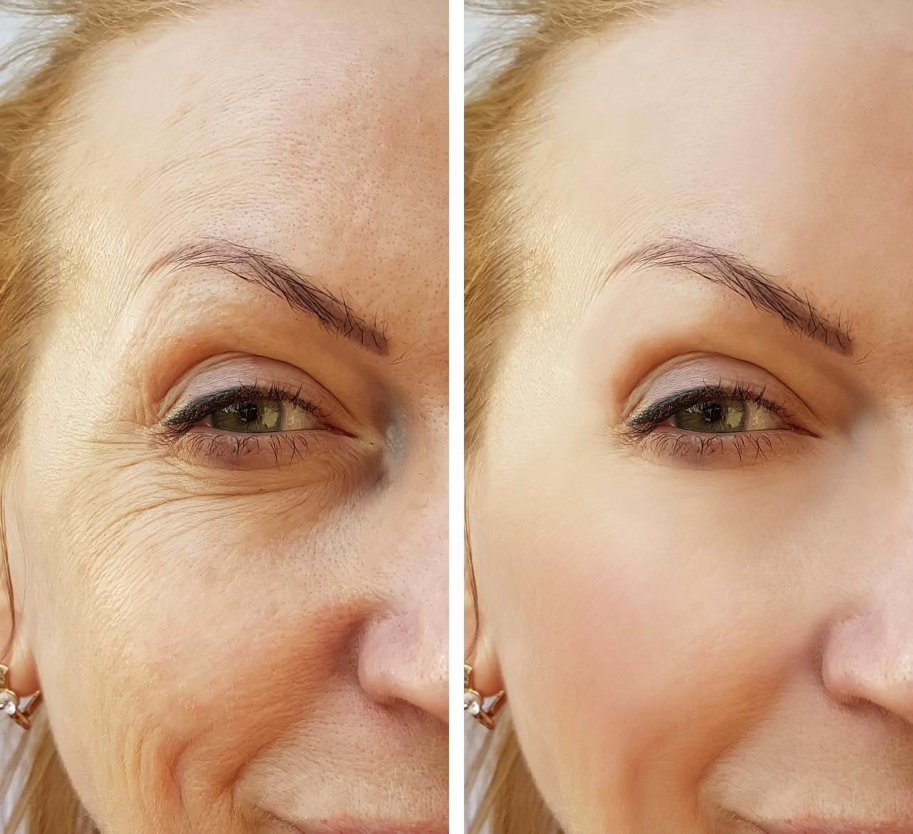 Common Botox and Juvederm filler treatment areas at Sanctuary Laser in Pennington, NJ.