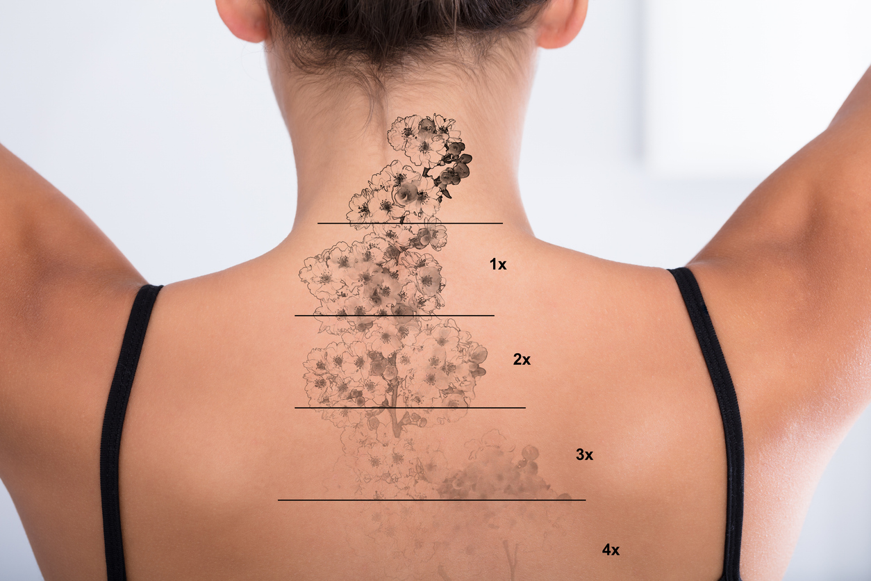 Patient with sculpted, naturally contoured silhouette after BeautiFill laser liposuction.