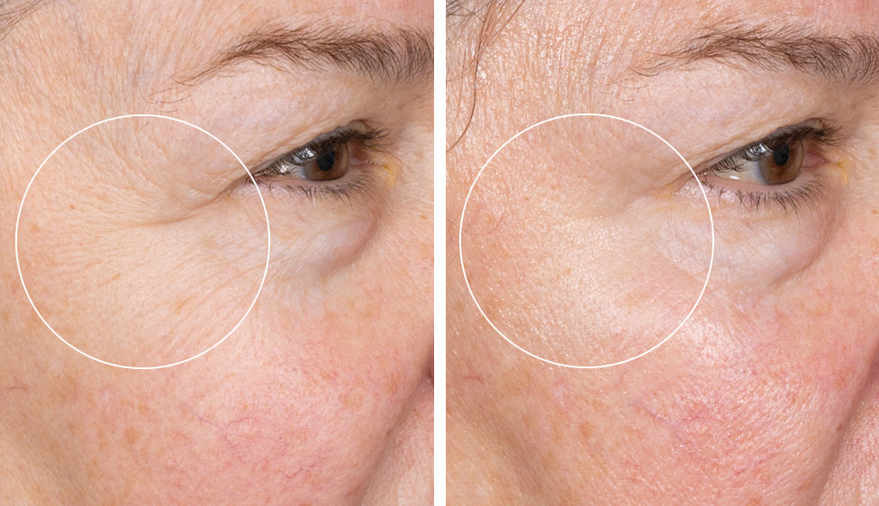 Close-up comparison of a woman's eye area before and after Hydrafacial treatment. The left side shows more wrinkles and texture, while the right side appears smoother and more youthful.
