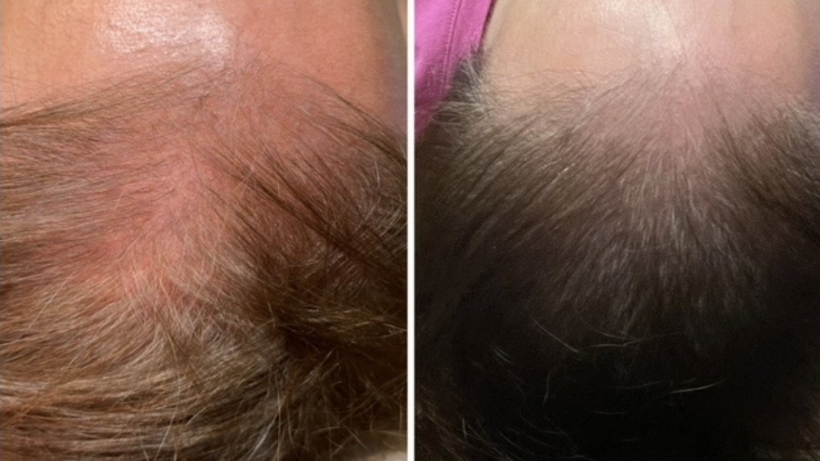 Close-up before-and-after comparison of Hydrafacial Keravive treatment. Left: sparse, grey hair on a scalp. Right: thicker, fuller hair growth.
