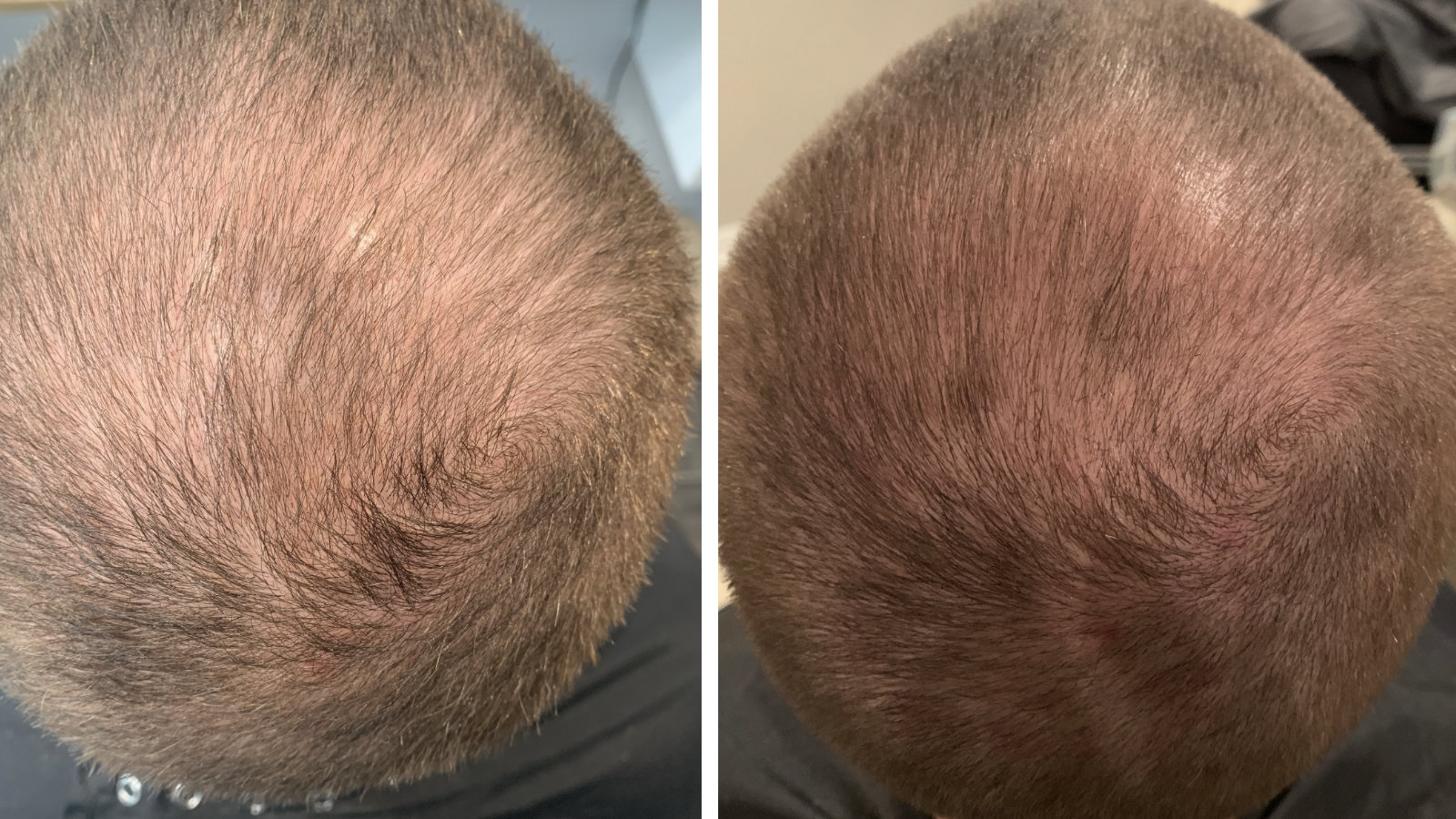 Hydrafacial Keravive before and after images of the top of a person’s head, showing hair thinning on the left and denser, thicker hair growth on the right.