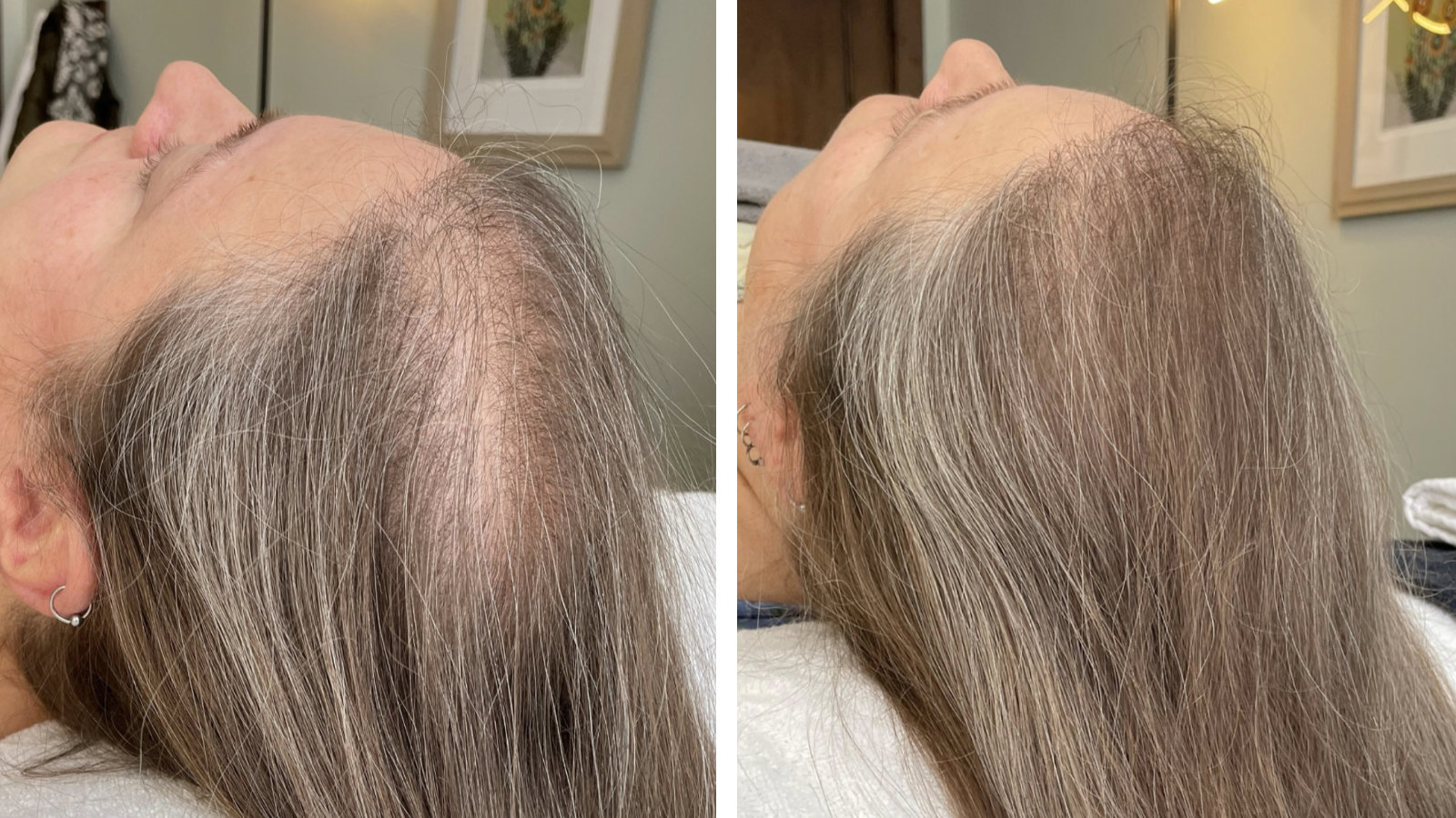 Side-by-side comparison of a woman's scalp before and after Hydrafacial Keravive treatment. On the left, thinning grey hair; on the right, thicker, fuller grey hair.
