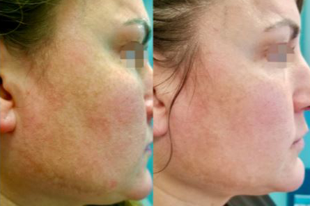 Side-by-side comparison of a woman's cheek and jawline before and after Alma Harmony skin treatment, showing reduced redness and smoother texture.