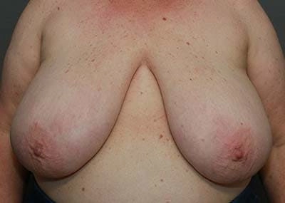 A frontal view of a person's upper chest showing prominent breasts with no visible clothing over the area.