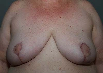 An image showing the upper torso of a person with visible post-surgical marks on the breasts, indicating a breast reduction procedure.