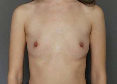 A frontal view of a torso of a woman with no visible clothing on the upper body.