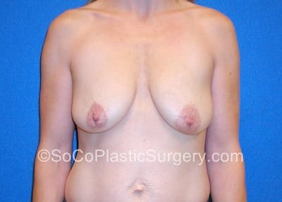 A frontal view of a woman’s upper body, showcasing breasts with visible areolas and a navel, with the text 'SoCoPlasticSurgery.com' in light text at the bottom.