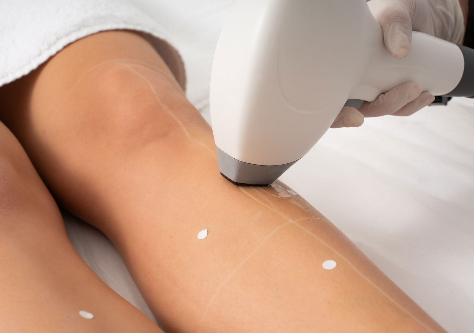 Beine dauerhafte Haarentfernung