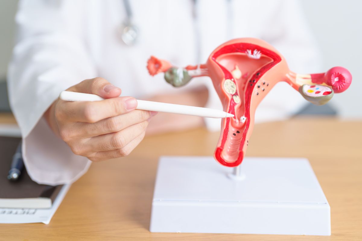 Guide to Removing a Fibroid from the Uterus