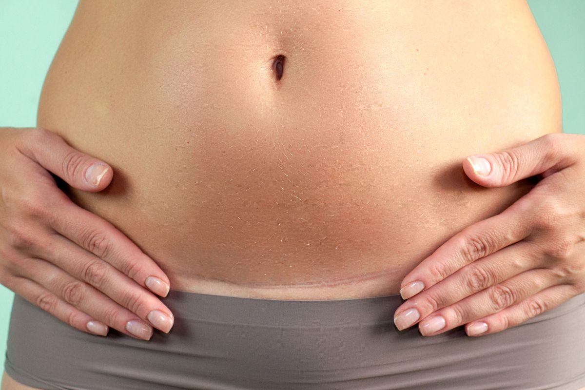hysterectomy scar close up