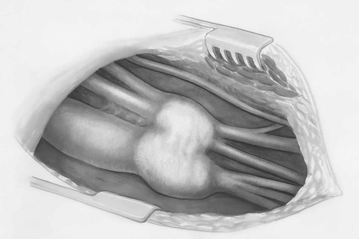 Guide to Removing a Fibroid from the Uterus