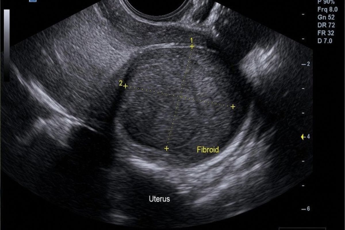 fibroid echo