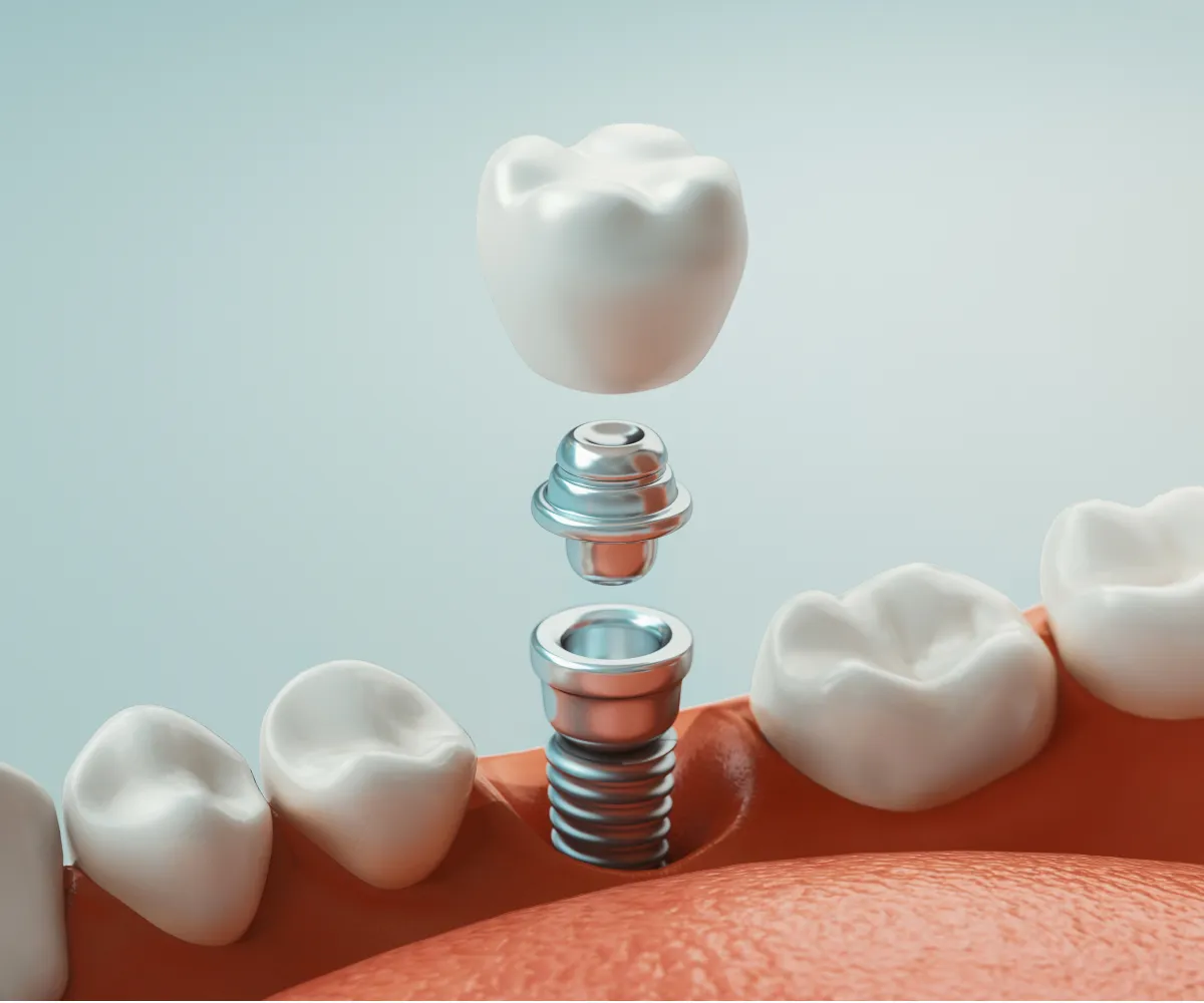 A dental implant is shown, with parts fitting together to replace a missing tooth in the gum.
