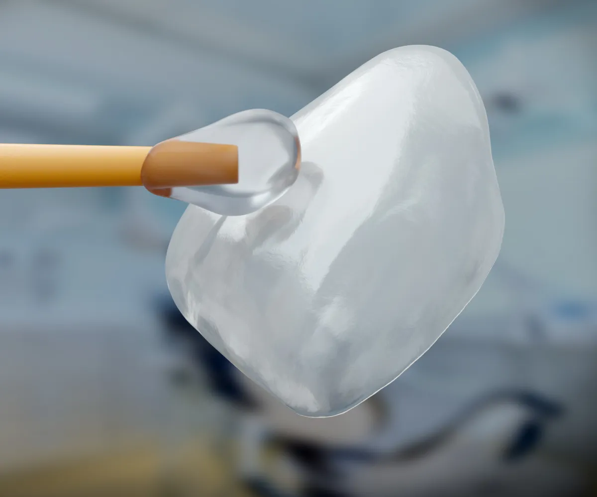 A dental veneer being applied to a tooth with a tool.