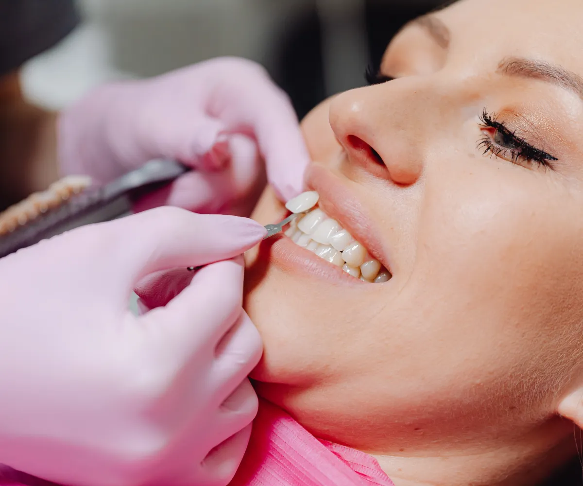 A dentist applies a dental veneer to a patient's tooth with gloved hands.