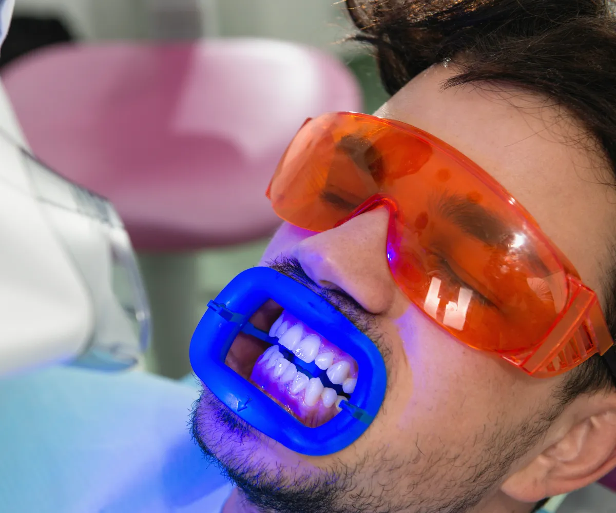 Person receiving a teeth whitening treatment, wearing protective orange glasses and a blue mouth guard.