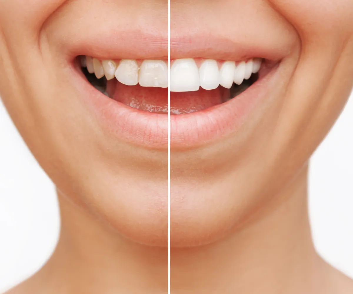 Close-up of a woman's mouth showing teeth before and after whitening, with a visible dividing line.