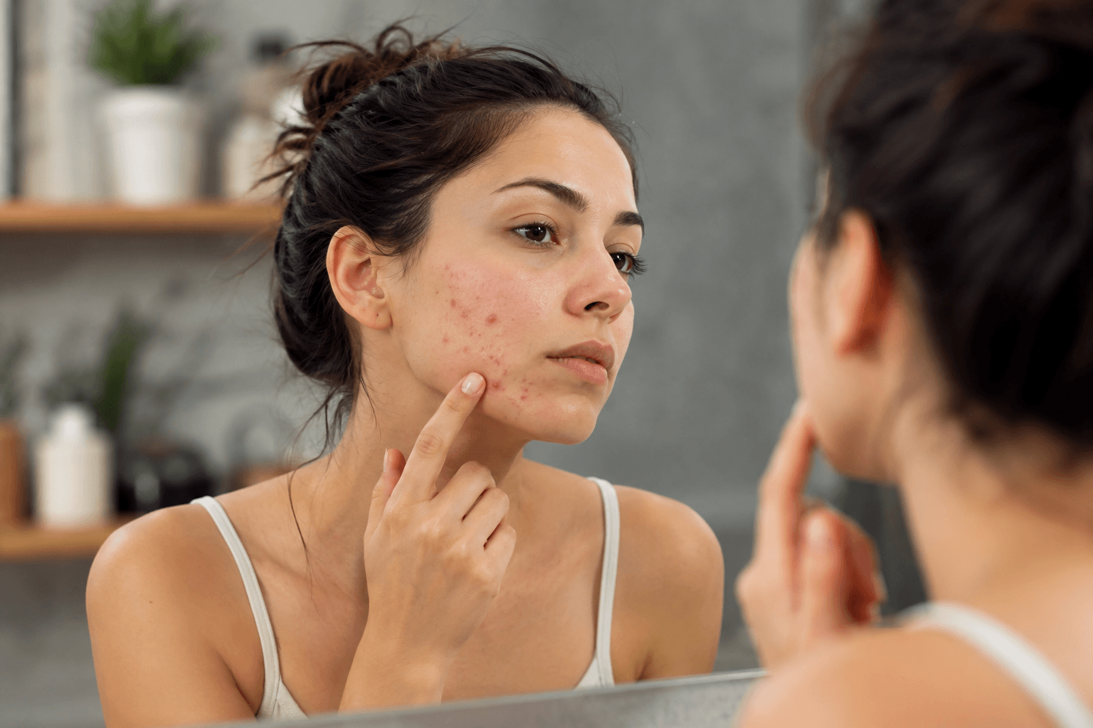 Client receiving professional acne treatment in Costa Mesa, California for persistent breakouts and acne scarring