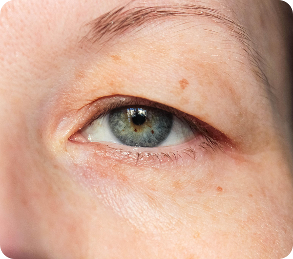 Eyelid Disorders