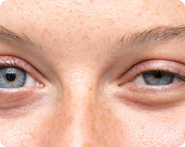 swollen eyelids