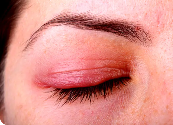 Red Eye lid